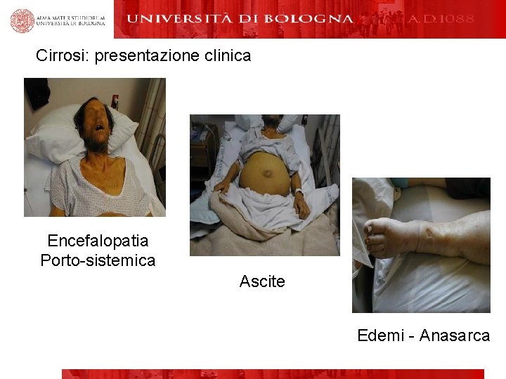 Cirrosi: presentazione clinica Encefalopatia Porto-sistemica Ascite Edemi - Anasarca 