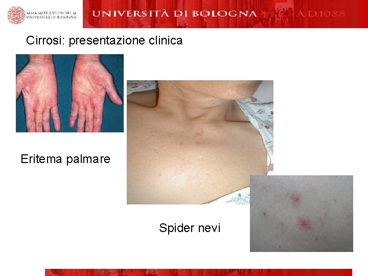 Cirrosi: presentazione clinica ERITEMA PALMARE Eritema palmare Spider nevi 