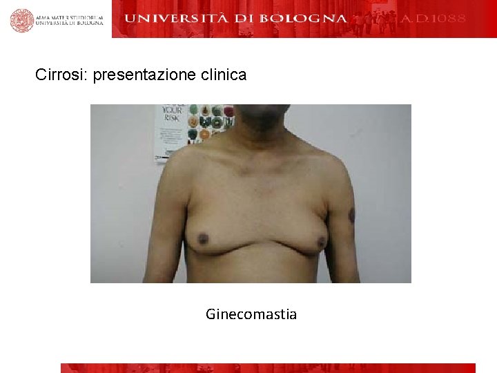 Cirrosi: presentazione clinica Ginecomastia 