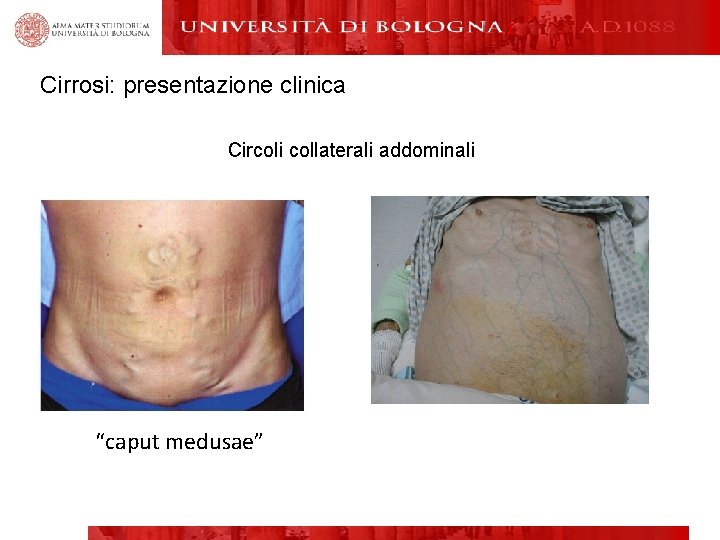 Cirrosi: presentazione clinica Circoli collaterali addominali “caput medusae” 