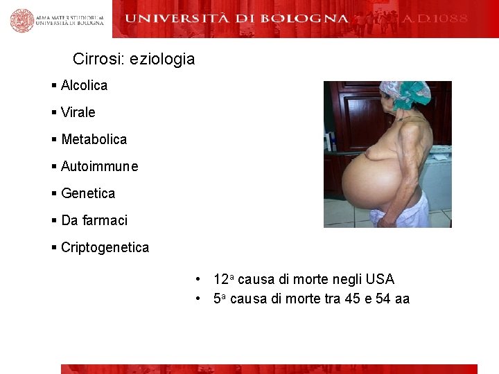 Cirrosi: eziologia § Alcolica § Virale § Metabolica § Autoimmune § Genetica § Da