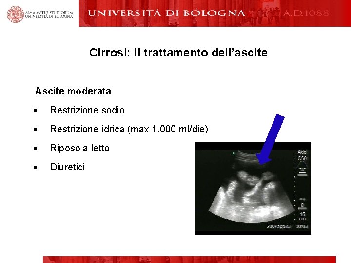 Cirrosi: il trattamento dell’ascite Ascite moderata § Restrizione sodio § Restrizione idrica (max 1.