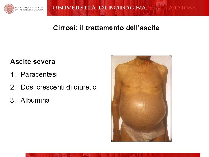 Cirrosi: il trattamento dell’ascite Ascite severa 1. Paracentesi 2. Dosi crescenti di diuretici 3.