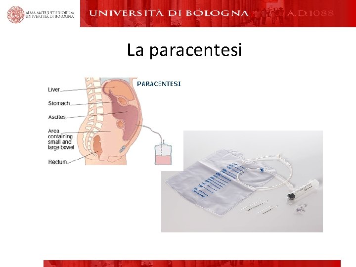 La paracentesi 