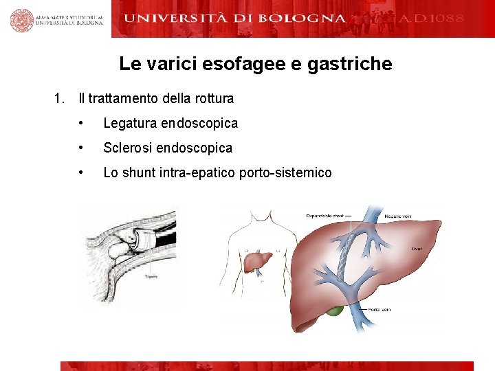Le varici esofagee e gastriche 1. Il trattamento della rottura • Legatura endoscopica •