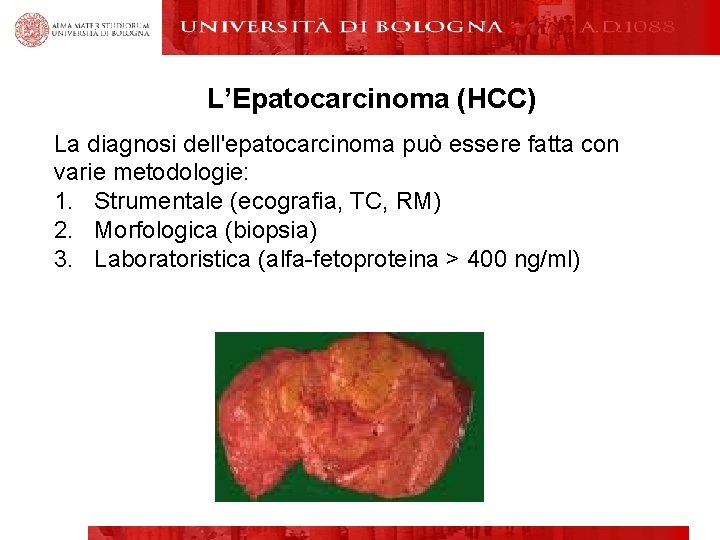 L’Epatocarcinoma (HCC) La diagnosi dell'epatocarcinoma può essere fatta con varie metodologie: 1. Strumentale (ecografia,