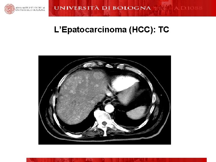 L’Epatocarcinoma (HCC): TC 