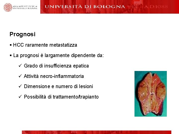 Prognosi § HCC raramente metastatizza § La prognosi è largamente dipendente da: ü Grado