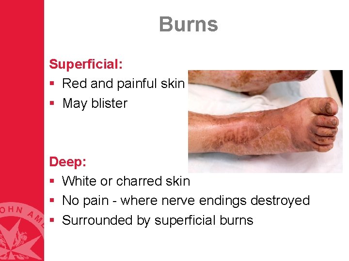 Burns Superficial: § Red and painful skin § May blister Deep: § White or Burns Superficial: § Red and painful skin § May blister Deep: § White or