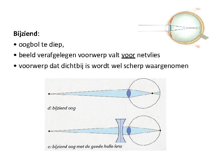 Bijziend: • oogbol te diep, • beeld verafgelegen voorwerp valt voor netvlies • voorwerp