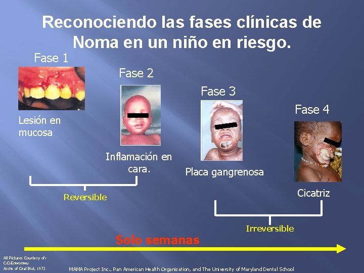 Reconociendo las fases clínicas de Noma en un niño en riesgo. Fase 1 Fase