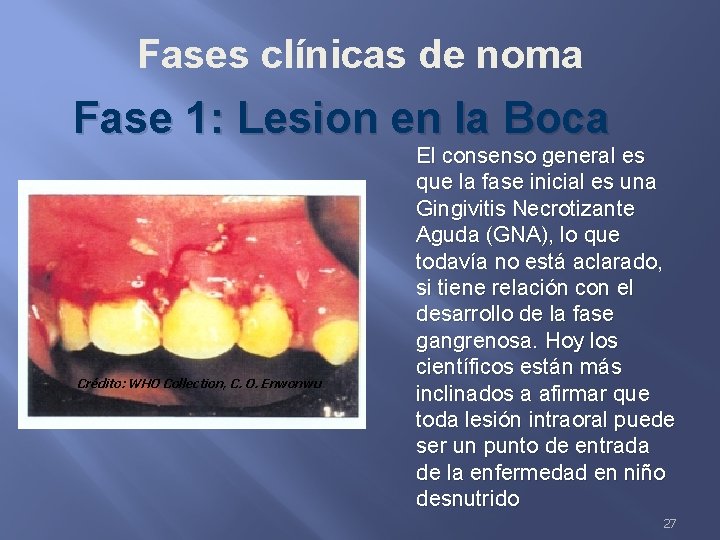 Fases clínicas de noma Fase 1: Lesion en la Boca Crédito: WHO Collection, C.