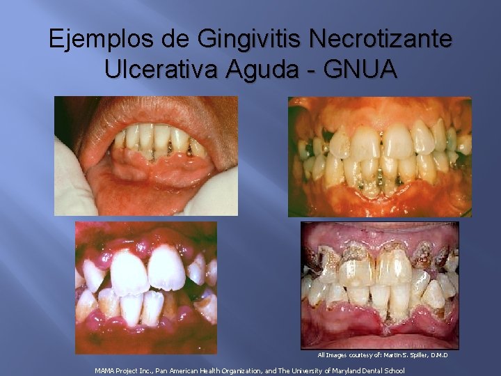 Ejemplos de Gingivitis Necrotizante Ulcerativa Aguda - GNUA All Images courtesy of: Martin S.