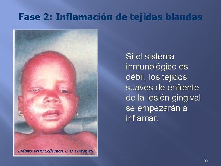 Fase 2: Inflamación de tejidas blandas Si el sistema inmunológico es débil, los tejidos