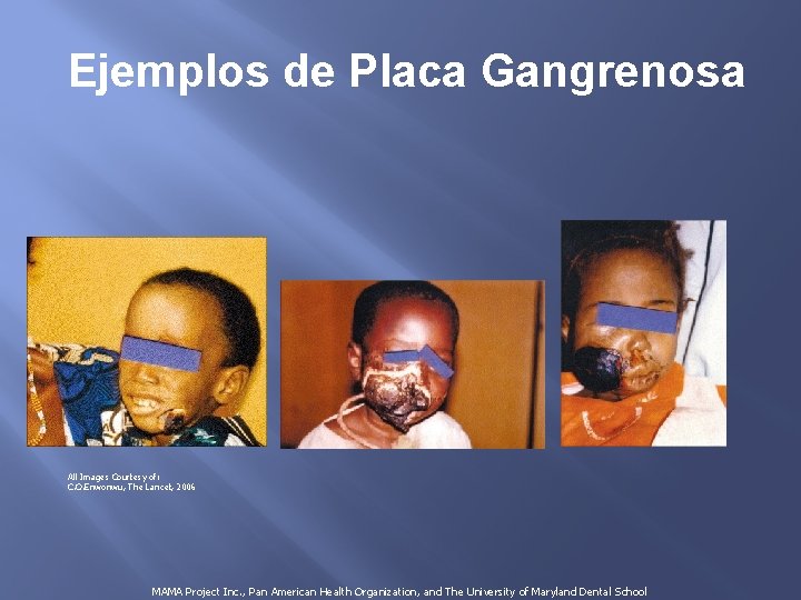 Ejemplos de Placa Gangrenosa All Images Courtesy of: C. O. Enwonwu, The Lancet, 2006