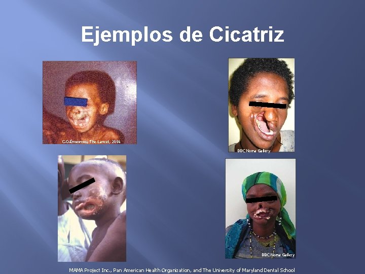 Ejemplos de Cicatriz C. O. Enwonwu, The Lancet, 2006 BBC Noma Gallery MAMA Project