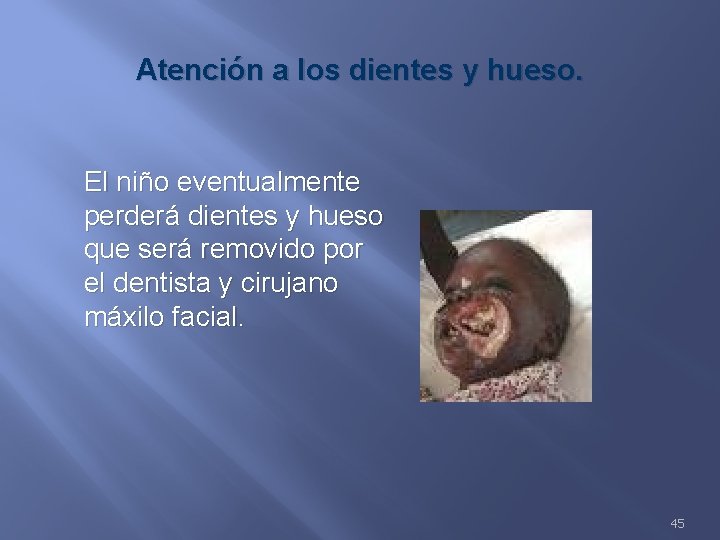 Atención a los dientes y hueso. El niño eventualmente perderá dientes y hueso que