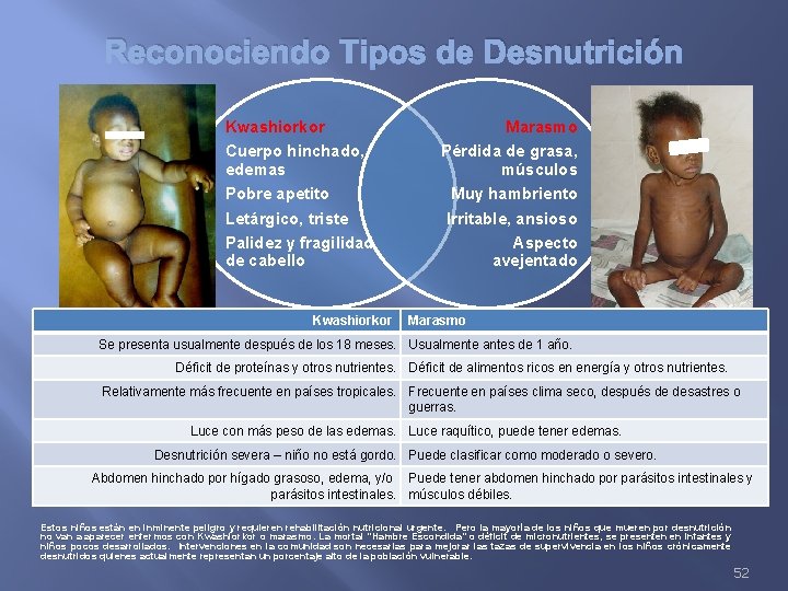 Reconociendo Tipos de Desnutrición Kwashiorkor Cuerpo hinchado, edemas Pobre apetito Letárgico, triste Palidez y