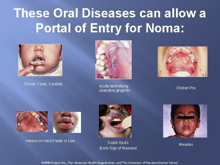 These Oral Diseases can allow a Portal of Entry for Noma: Thrush, Yeast, Candida