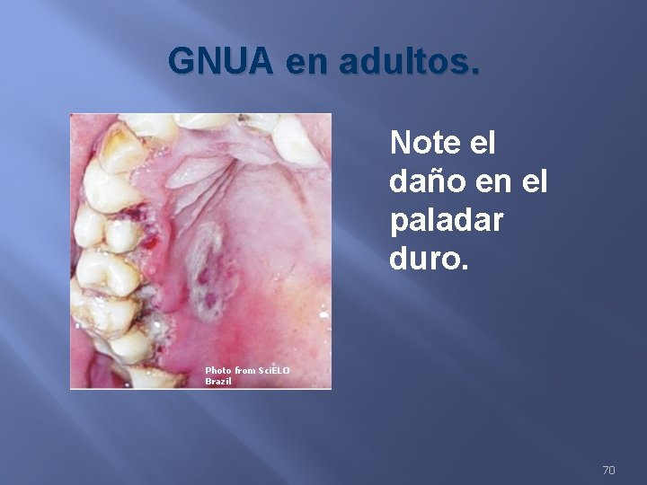 GNUA en adultos. Note el daño en el paladar duro. Photo from Sci. ELO