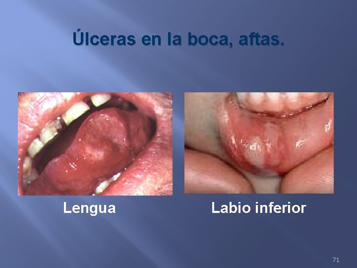 Úlceras en la boca, aftas. Lengua Labio inferior 71 