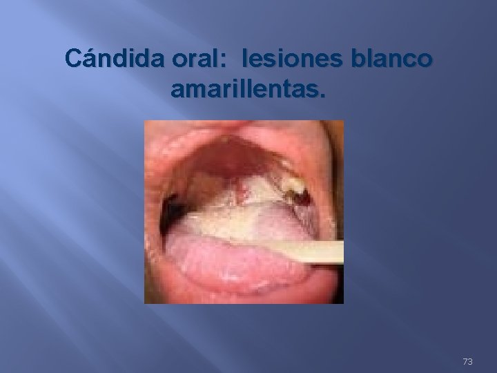 Cándida oral: lesiones blanco amarillentas. 73 