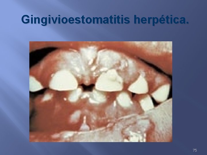 Gingivioestomatitis herpética. 75 
