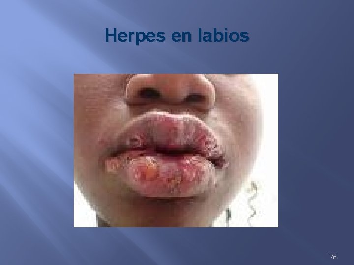 Herpes en labios 76 