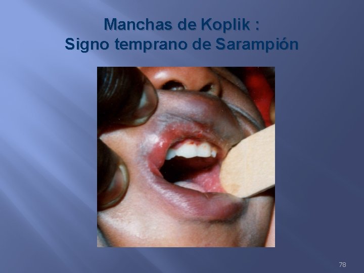 Manchas de Koplik : Signo temprano de Sarampión 78 