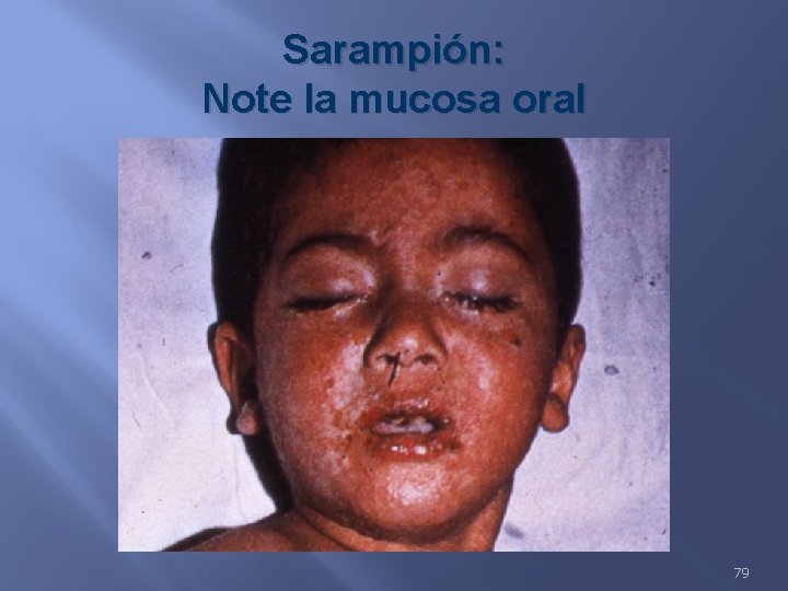 Sarampión: Note la mucosa oral 79 