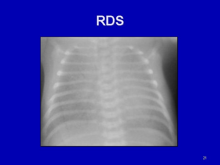 RDS 21 