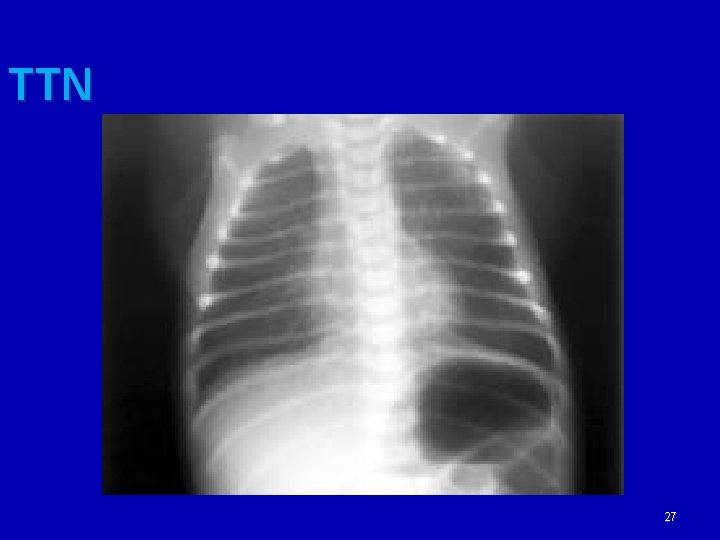 TTN 27 
