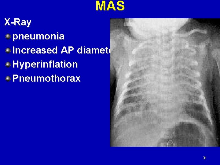 MAS X-Ray pneumonia Increased AP diameter Hyperinflation Pneumothorax 31 