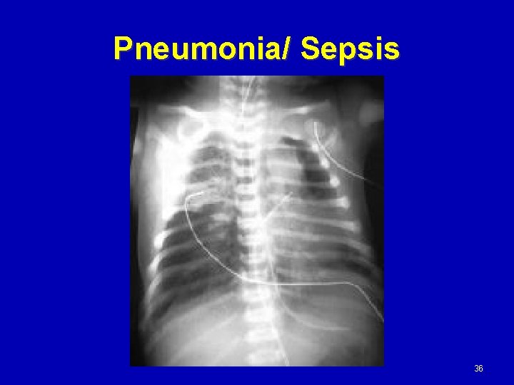 Pneumonia/ Sepsis 36 
