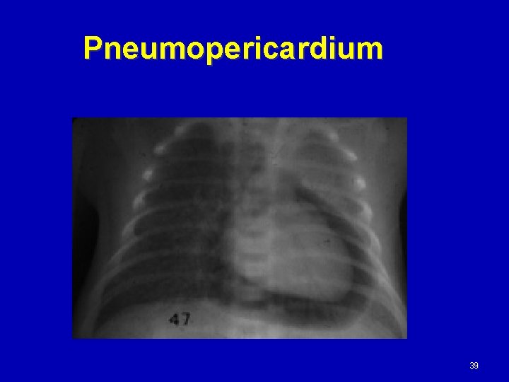 Pneumopericardium 39 