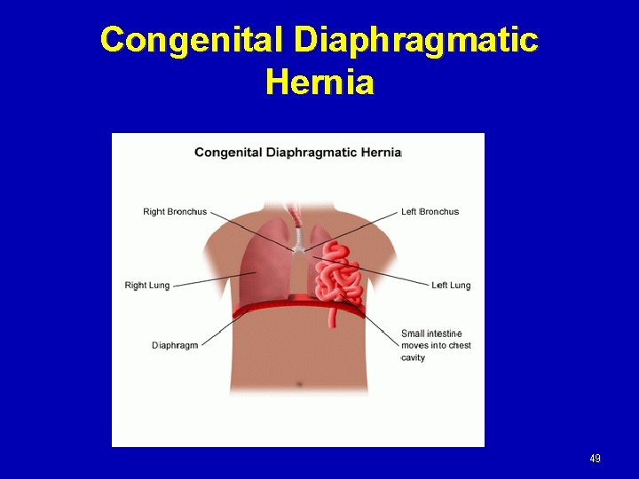 Congenital Diaphragmatic Hernia 49 