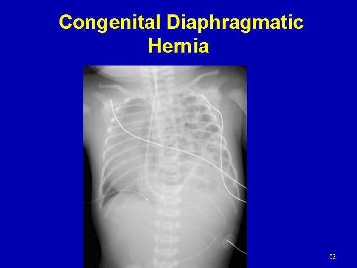 Congenital Diaphragmatic Hernia 52 