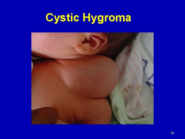 Cystic Hygroma 54 