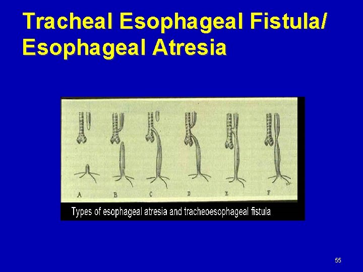 Tracheal Esophageal Fistula/ Esophageal Atresia 55 