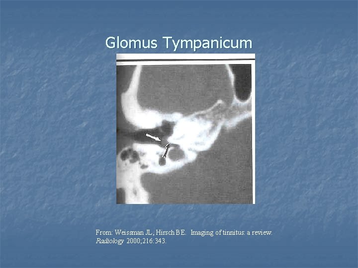 Glomus Tympanicum From: Weissman JL, Hirsch BE. Imaging of tinnitus: a review. Radiology 2000;