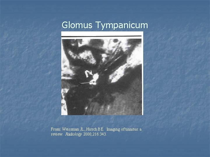 Glomus Tympanicum From: Weissman JL, Hirsch BE. Imaging of tinnitus: a review. Radiology 2000;