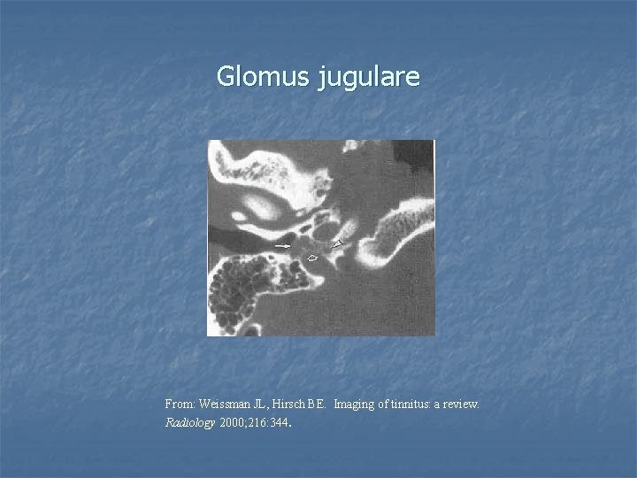 Glomus jugulare From: Weissman JL, Hirsch BE. Imaging of tinnitus: a review. Radiology 2000;