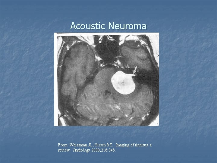 Acoustic Neuroma From: Weissman JL, Hirsch BE. Imaging of tinnitus: a review. Radiology 2000;