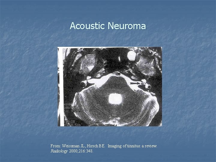 Acoustic Neuroma From: Weissman JL, Hirsch BE. Imaging of tinnitus: a review. Radiology 2000;