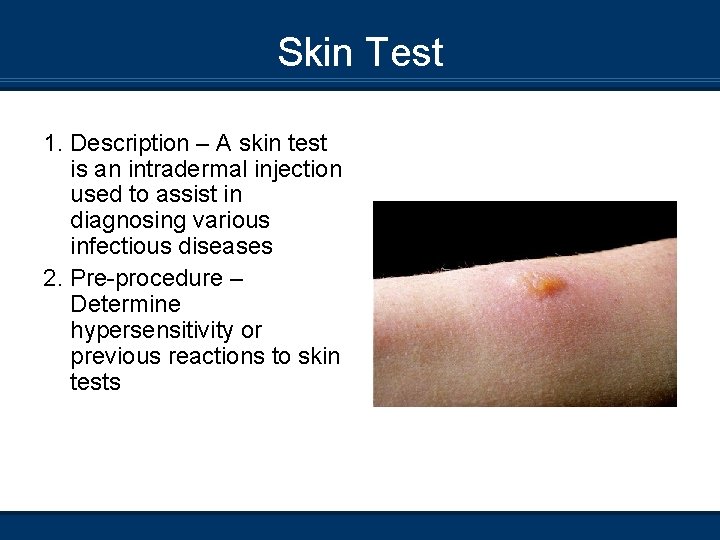 Skin Test 1. Description – A skin test is an intradermal injection used to