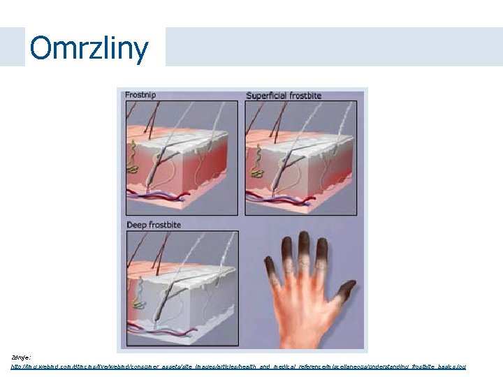 Omrzliny Zdroje: http: //img. webmd. com/dtmcms/live/webmd/consumer_assets/site_images/articles/health_and_medical_reference/miscellaneous/understanding_frostbite_basics. jpg 