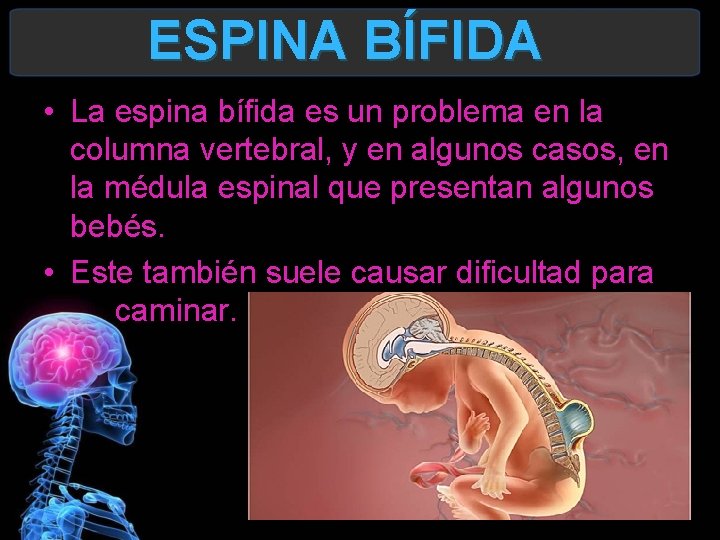 ESPINA BÍFIDA • La espina bífida es un problema en la columna vertebral, y