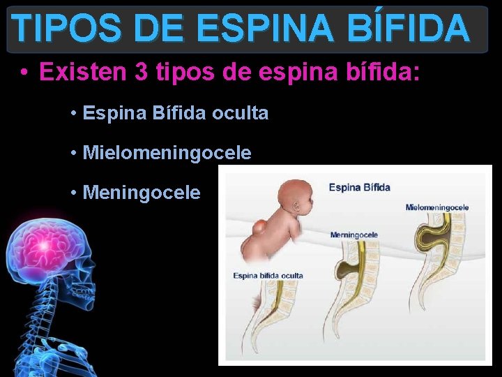 TIPOS DE ESPINA BÍFIDA • Existen 3 tipos de espina bífida: • Espina Bífida