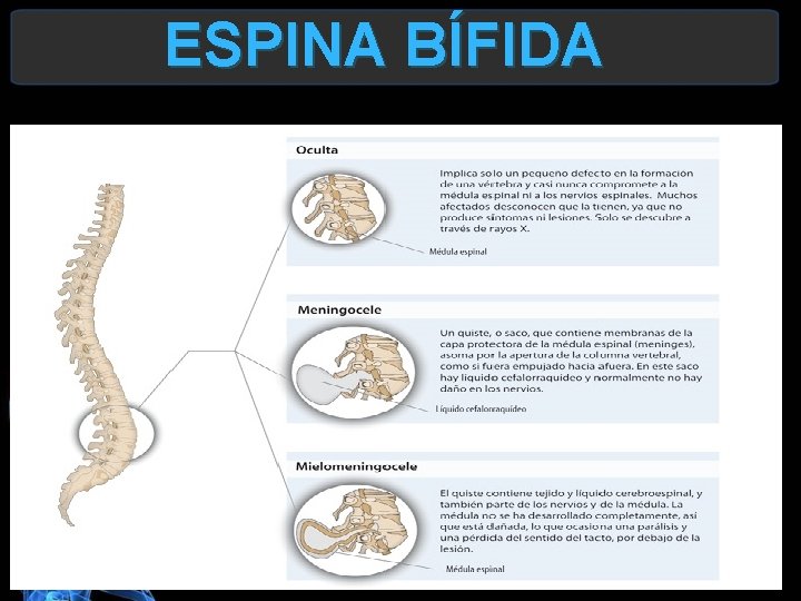 ESPINA BÍFIDA 