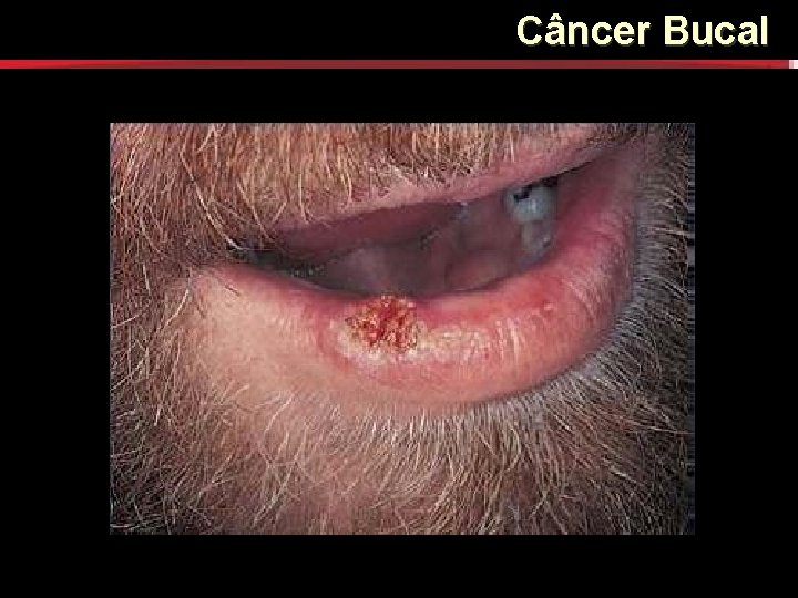 Câncer Bucal Câncer Bucal